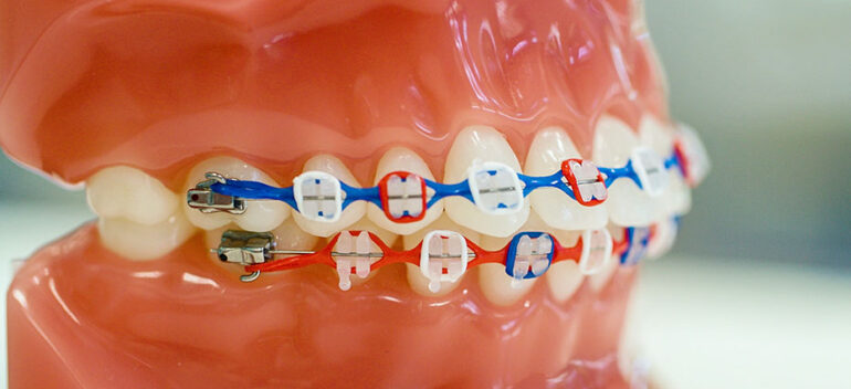 Ceramic Braces Deland Fl Orthodontist